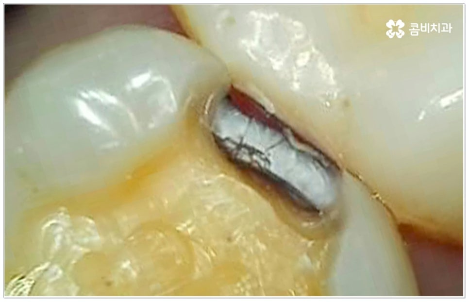 충치 인레이 언제 받나요? 관련 이미지 2