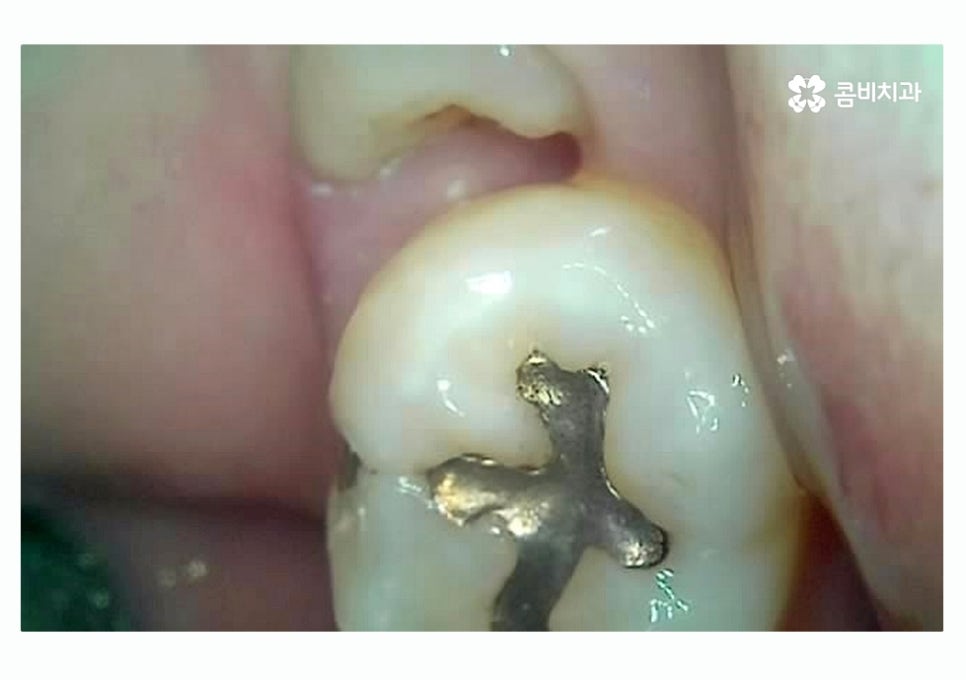 충치 떼우기 스무살이후에 조심해야 할 점은? 관련 이미지 4