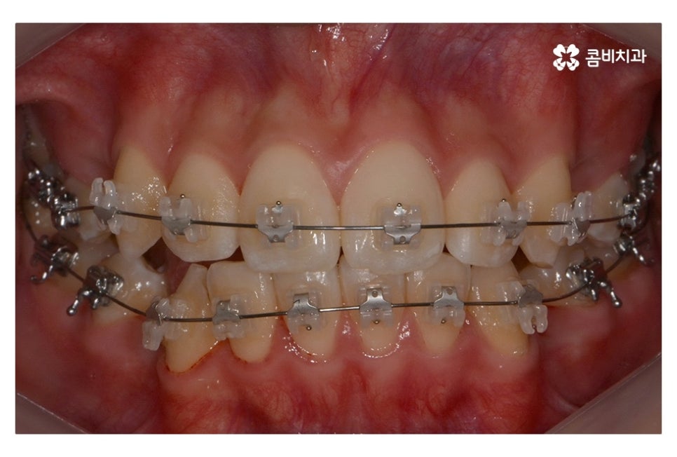 중학생치아교정 세심하게 체크하려면 관련 이미지 5