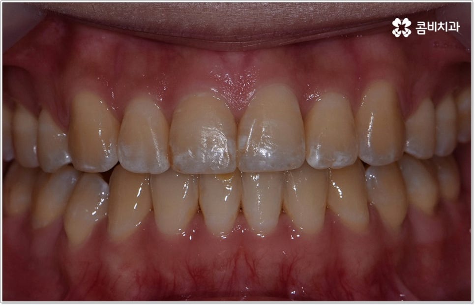 비발치치아교정 언제 할수있나요 관련 이미지 10