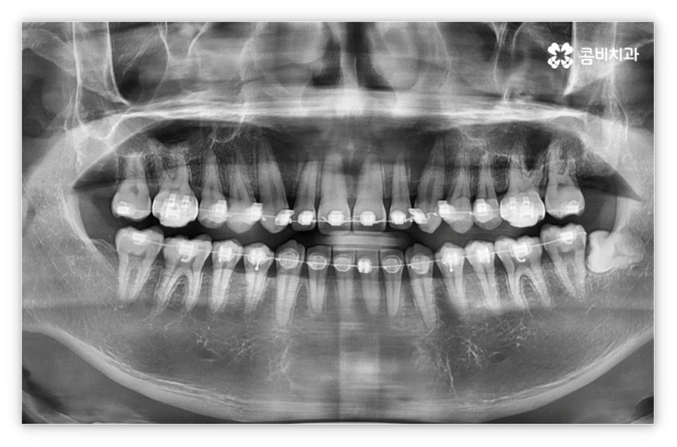 앞니설측교정 망설여질때는 관련 이미지 7