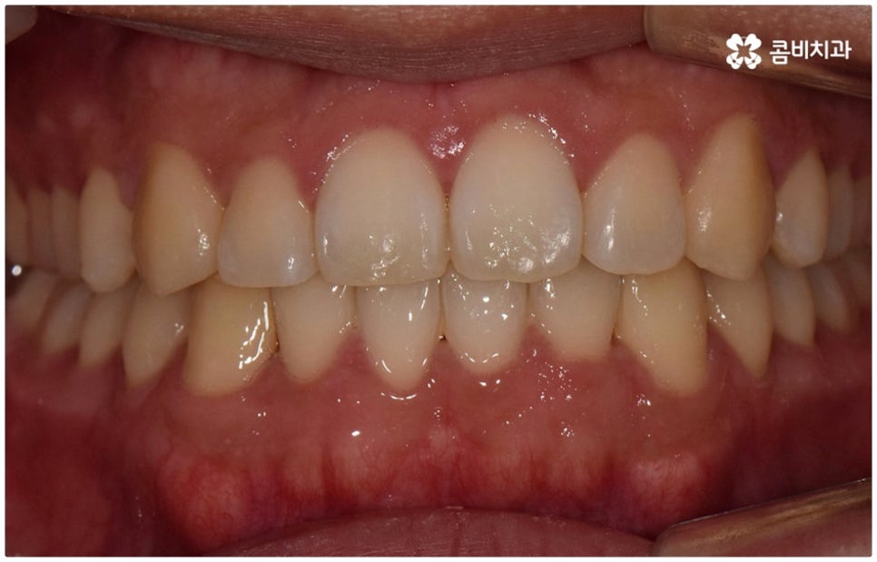 부정교합 3급 왜 고쳐야 하나요 관련 이미지 13