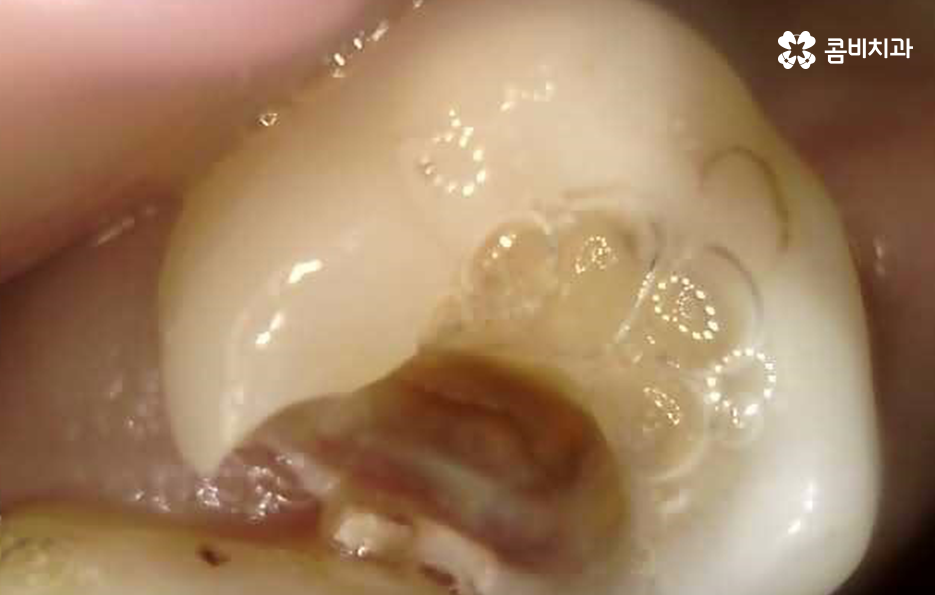 사랑니 어금니 통증 동시에 아프다면 관련 이미지 7