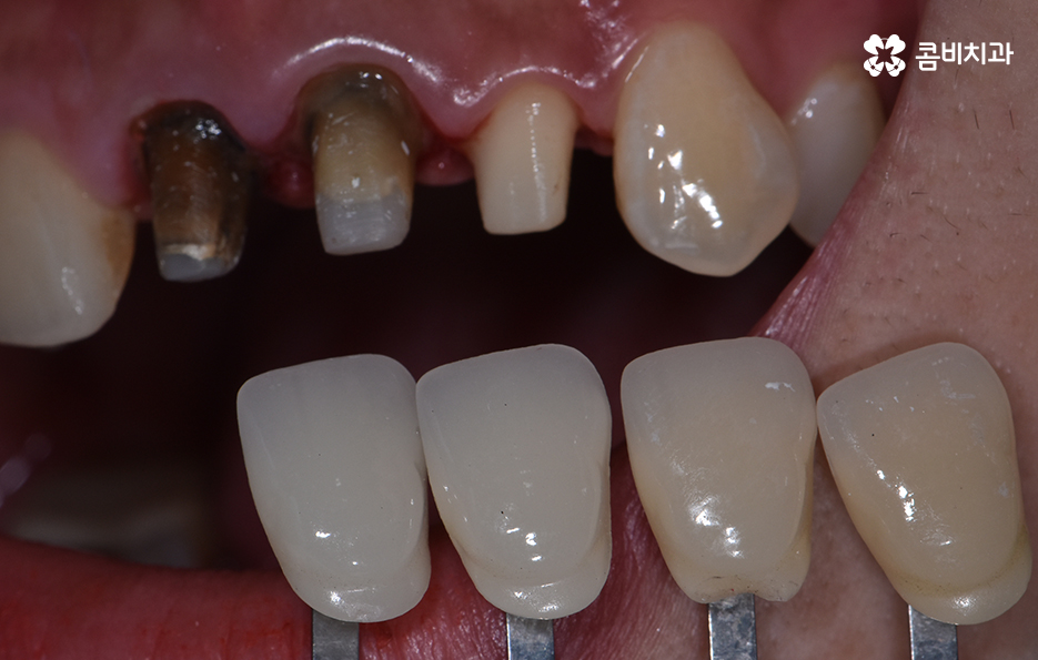 치아 깨짐 다시 튼튼하게 수복하기 위한 방법 관련 이미지 9