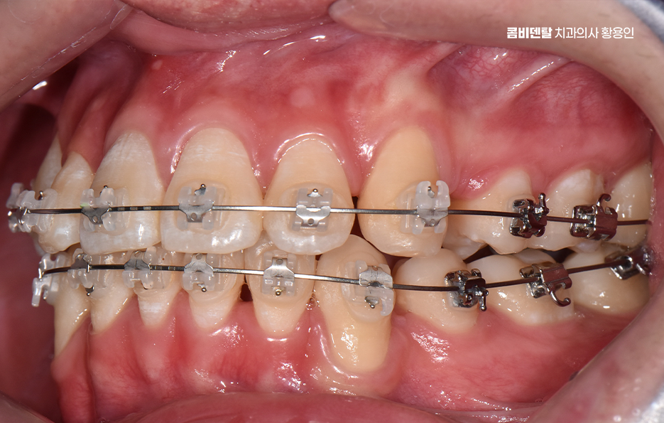 송곳니 덧니 발치 이럴때 해당되네요 관련 이미지 12