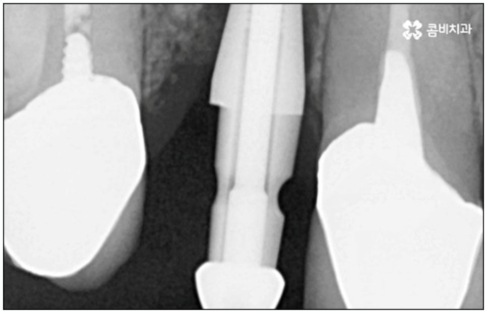 당일임플란트 나도 할수있나요 관련 이미지 10