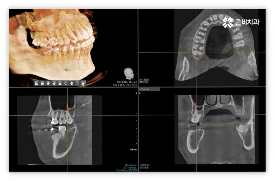 앞니설측교정 망설여질때는 관련 이미지 6