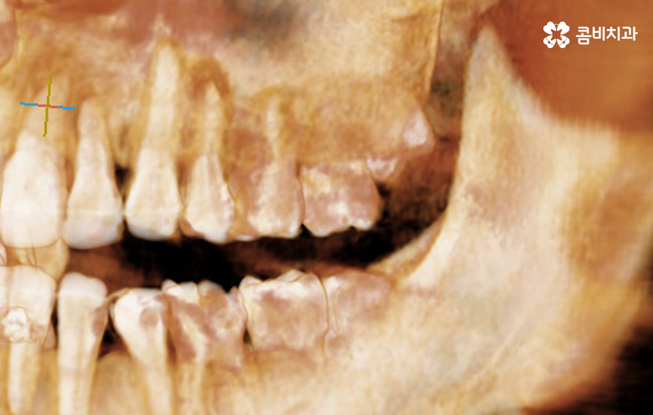 사랑니 어금니 통증 동시에 아프다면 관련 이미지 3