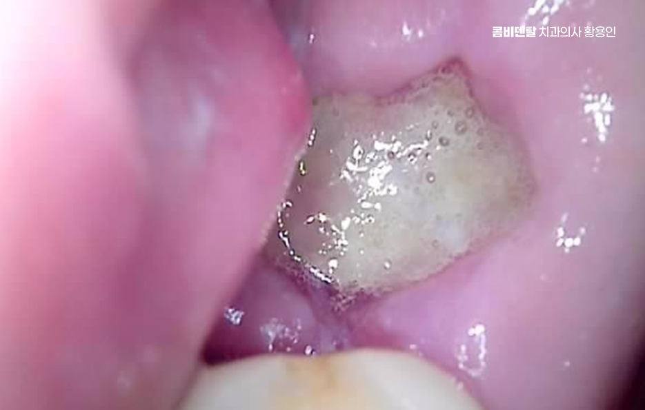 어금니 없으면 얼굴 발음에 어느정도나 안좋을까 관련 이미지 5