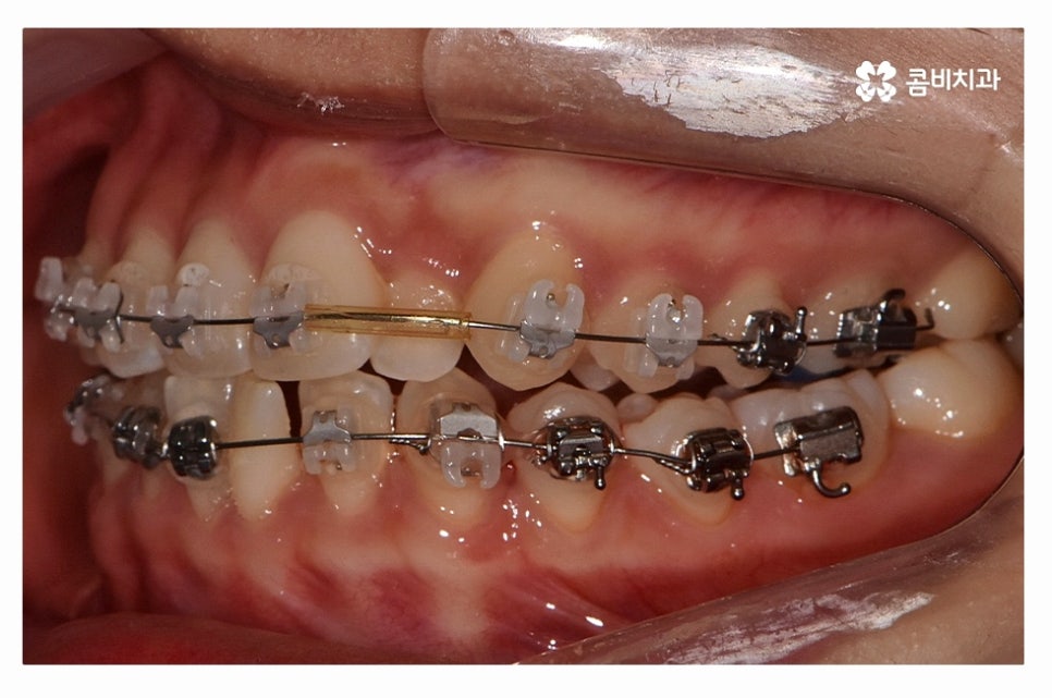 덧니교정 체계적으로 준비하려면 관련 이미지 6
