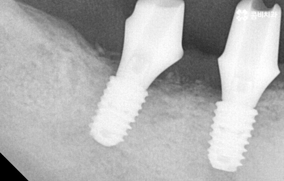 노인임플란트 이것만큼은 기억하세요 관련 이미지 8