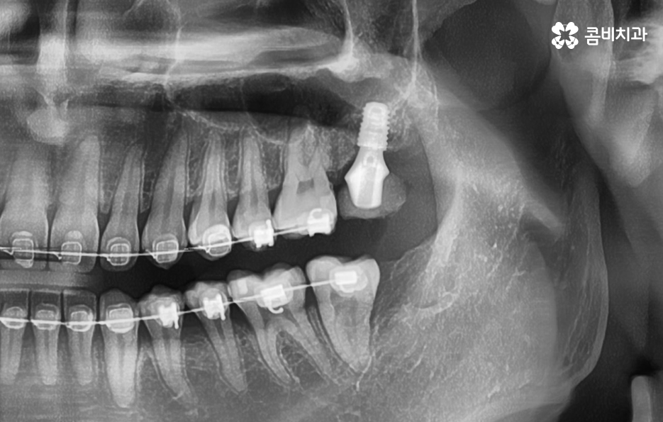 어금니 발치후 임플란트 이런점을 주의합시다 관련 이미지 7
