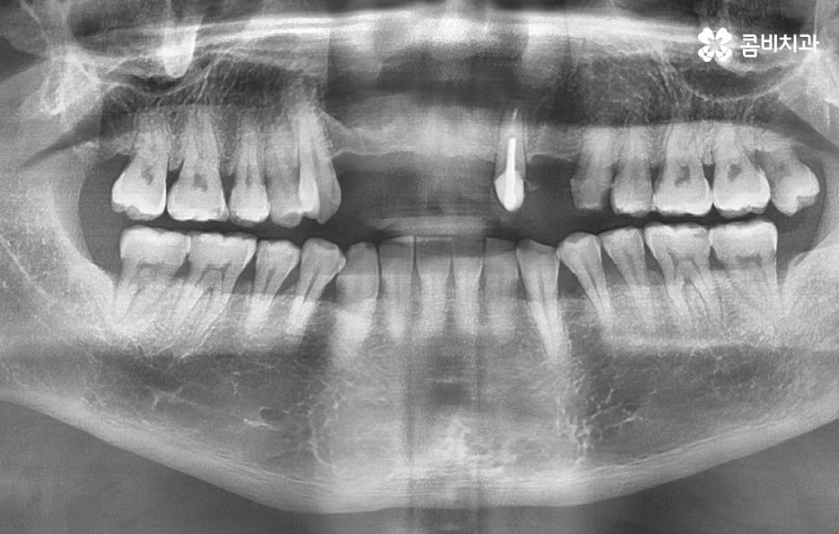 앞이빨 임플란트 과정 주의해야할 포인트는 관련 이미지 2