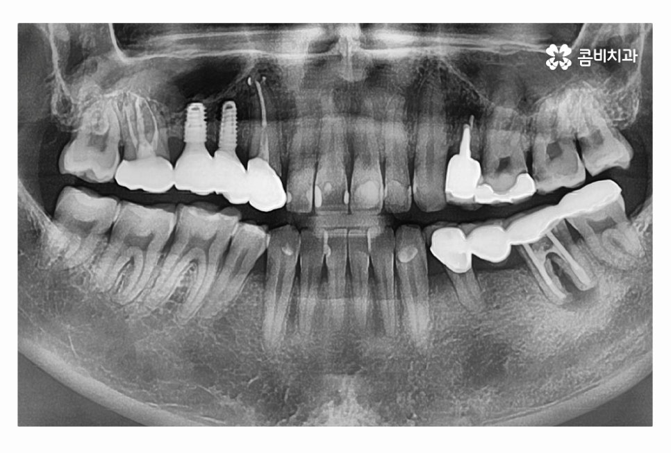 20대임플란트 갈수록 늘어나는 이유는 관련 이미지 13