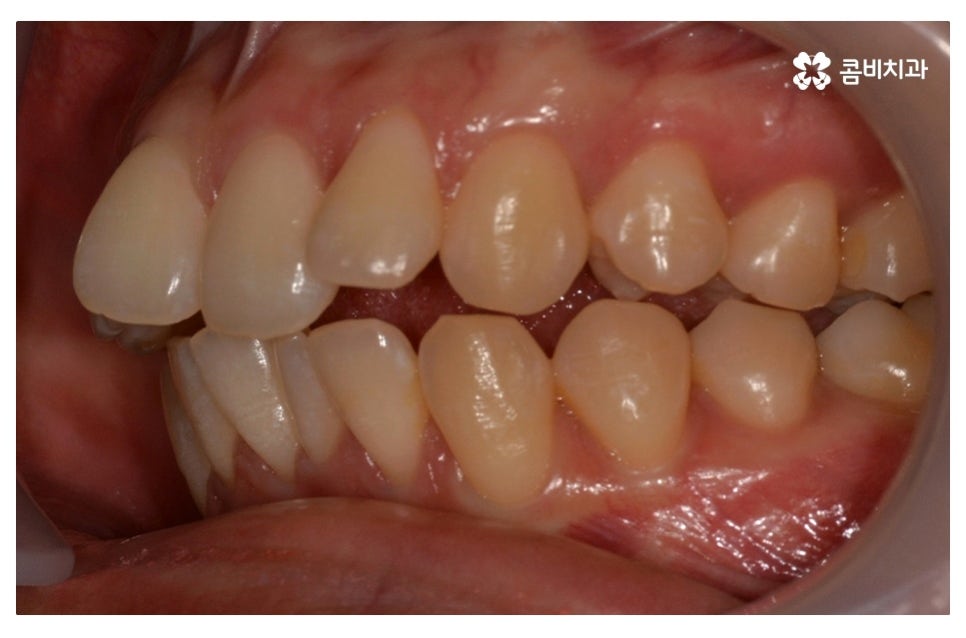 덧니교정 정확하게 알아보려면 관련 이미지 4