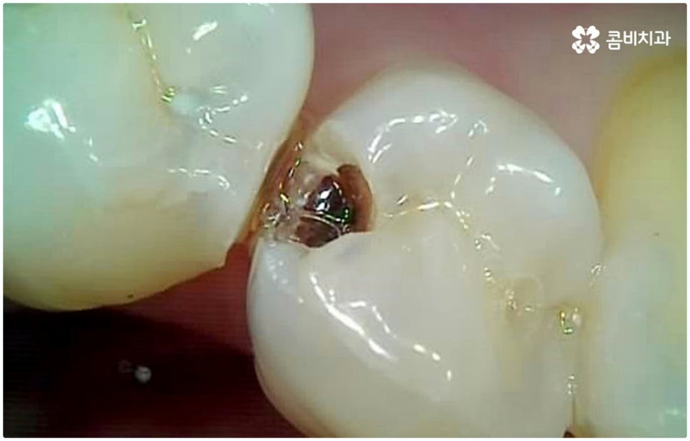 원데이임플란트 받고 싶으신가요? 관련 이미지 6