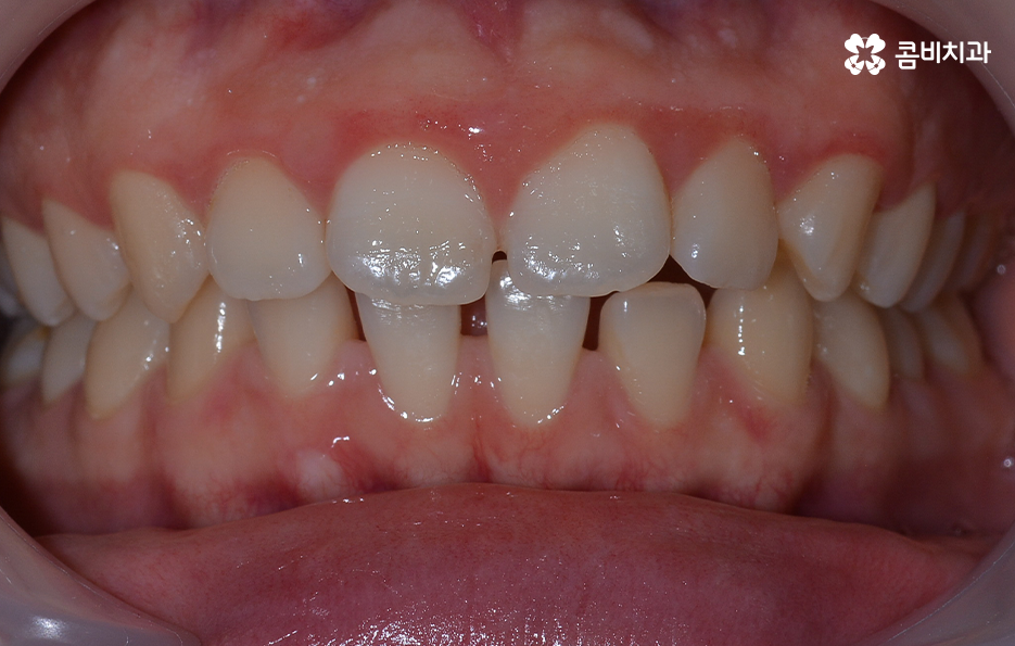 치아 벌어짐 교정으로 앞니 돌출까지 해결하기 관련 이미지 1