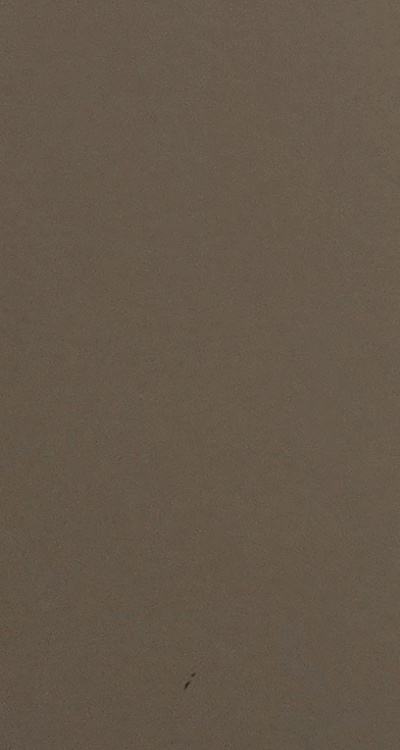 아말감 교체 레진 인레이 어떻게 대처하면 될까 관련 이미지 33