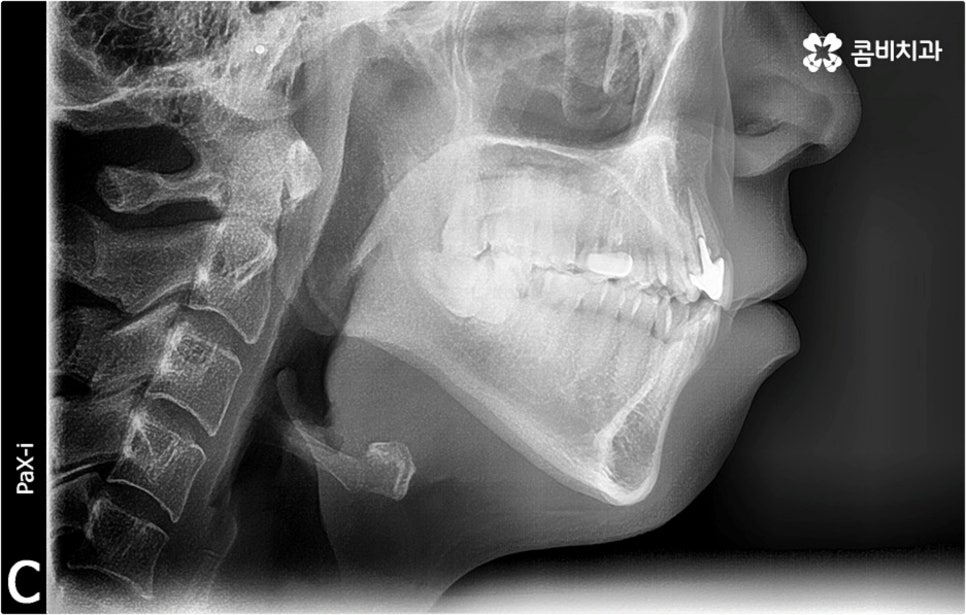 덧니교정 하고싶다면 관련 이미지 6
