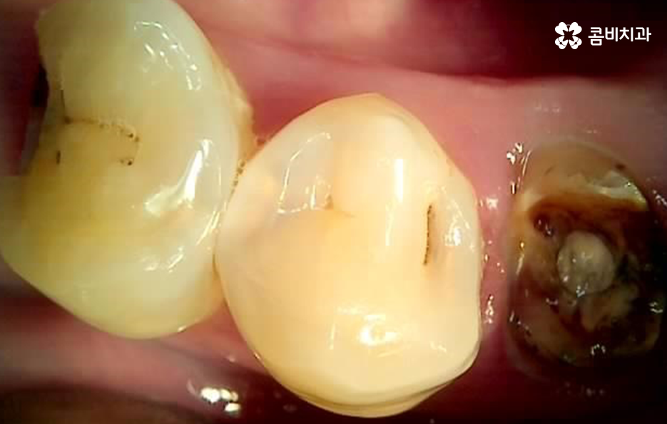 충치 단계 어떻게 분류하고 치료해야 하나요 관련 이미지 5