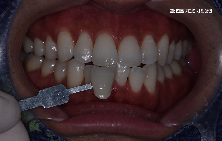 치과 치아미백 효과 어떤식으로 나타날까 관련 이미지 7