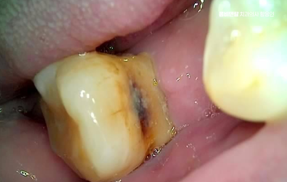 50대 임플란트 치과 지금부터 잘대처하려면 관련 이미지 4