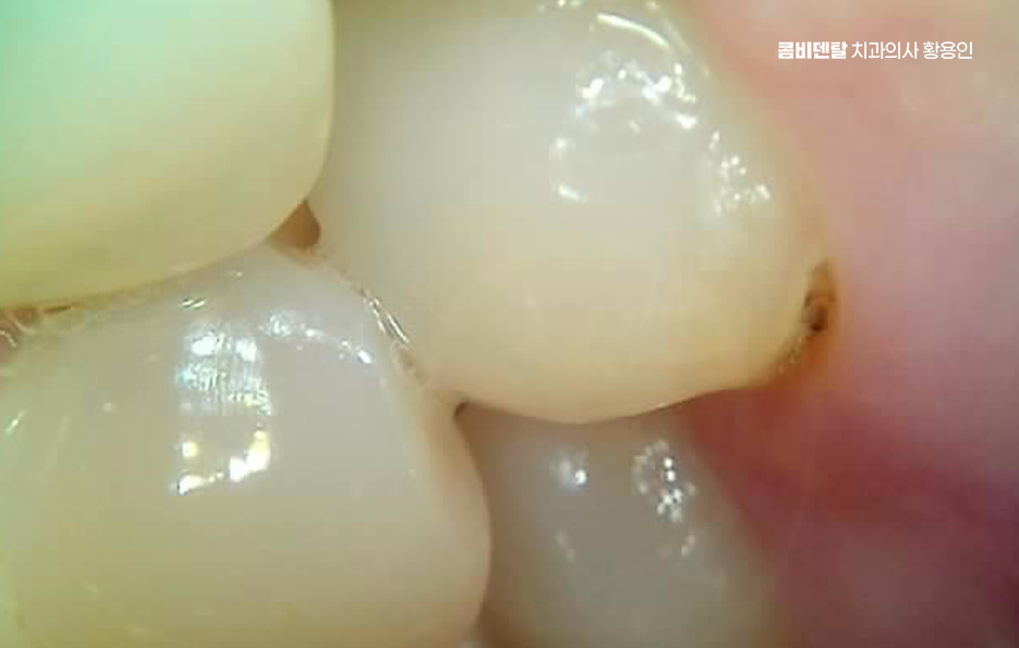 사랑니 주변 잇몸 통증 지금부터가 중요하니까 관련 이미지 7