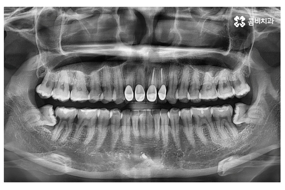 누운 사랑니 발치와 어금니신경치료를 하게 된 사례 관련 이미지 1
