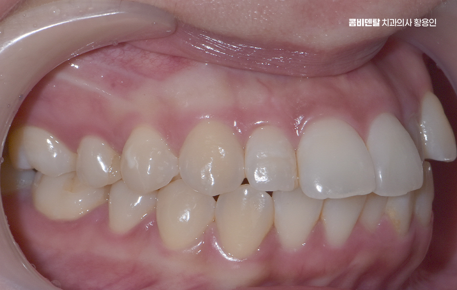 Could the Cause of Protruding Front Teeth Make a Difference? image 3