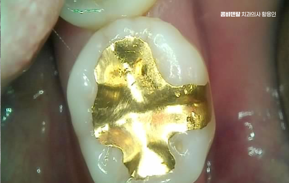 인레이 치료 후 통증 자꾸 심해지는데 괜찮은걸까 관련 이미지 2