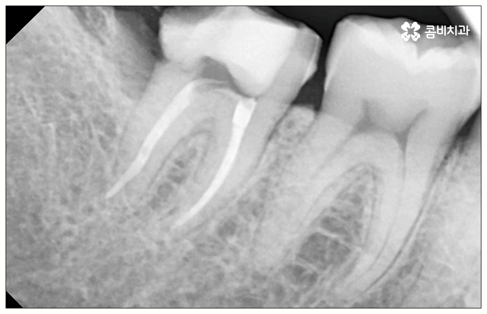 어금니 사이 충치 빠르게 대응해야 관련 이미지 8