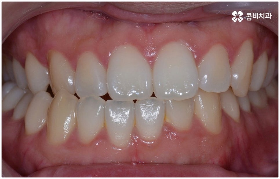부정교합 3급 왜 고쳐야 하나요 관련 이미지 4