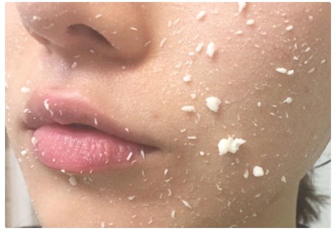 얼굴피지제거 빠르게 하는 방법! 관련 이미지 6