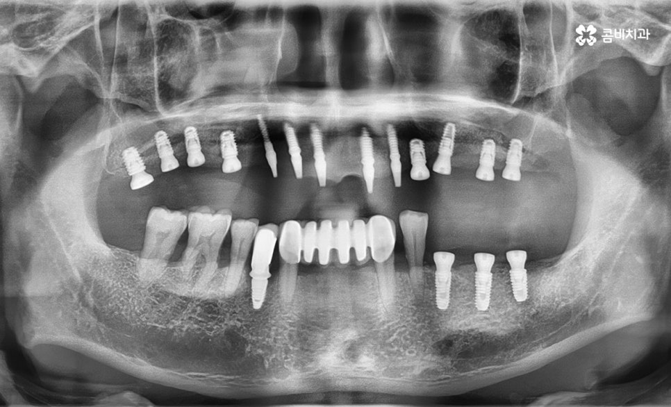 임플란트 수술 여전히 결코 간단하게 볼 수 없는 이유 관련 이미지 4