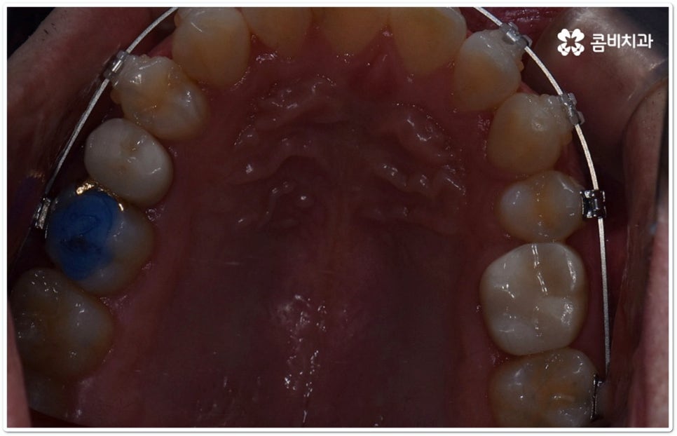 클리피씨교정 합리적인 초이스! 관련 이미지 10