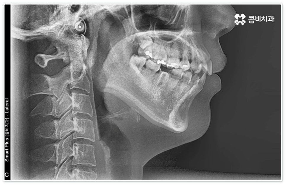 신경치료통증 무섭다고 미루면 관련 이미지 2
