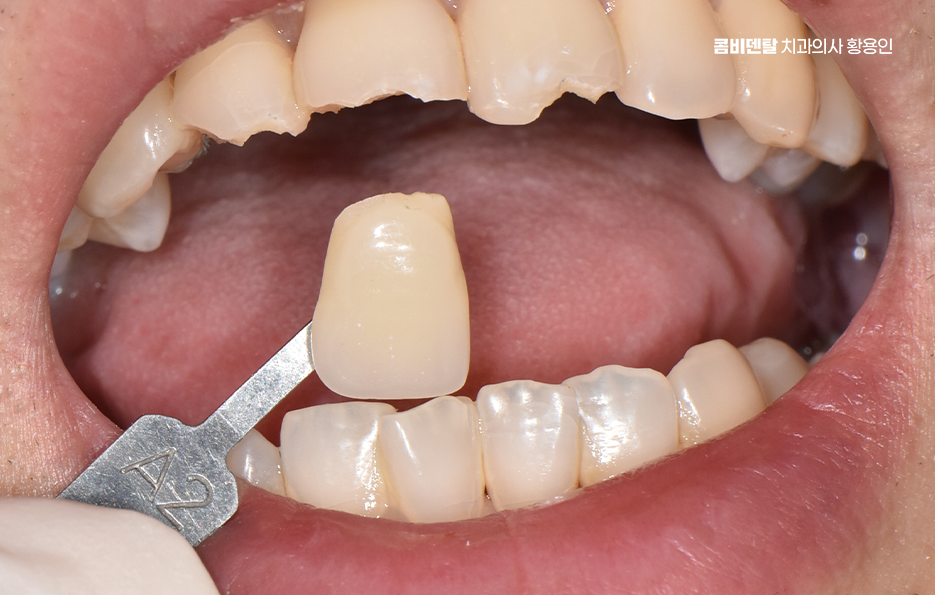 How to Use Laminate Veneers for Chipped Front Teeth image 2
