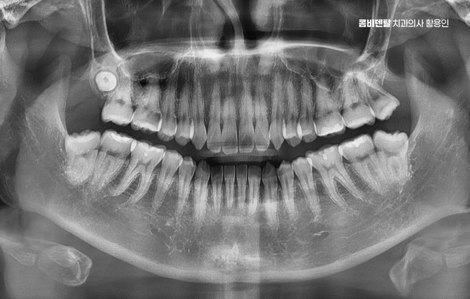 명동치과 흔하게 놓치는 사례를 정리해요 관련 이미지 1