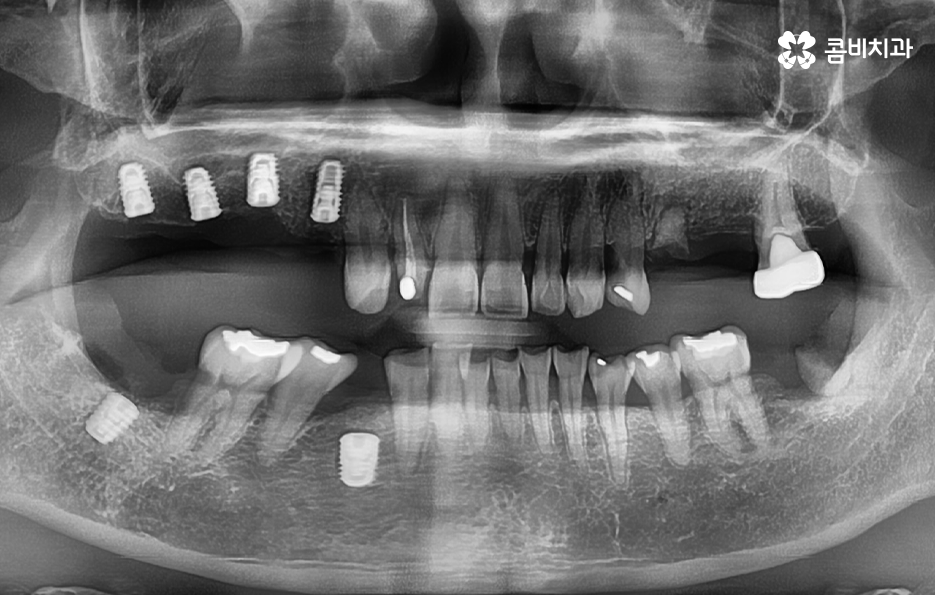 임플란트 치료기간 어느정도 걸리고 치과에는 몇번 가나요 관련 이미지 4