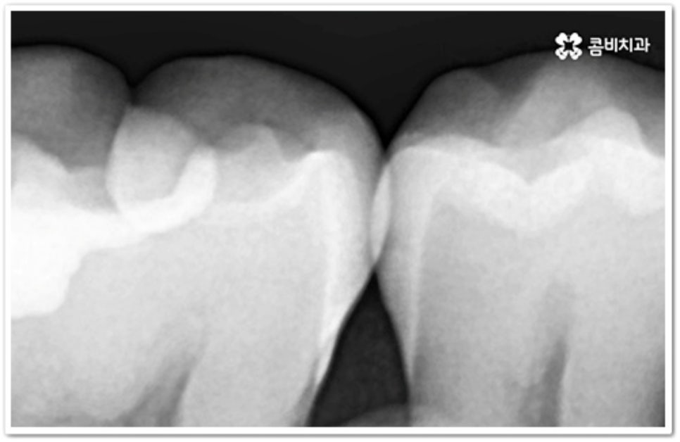 인접면 충치 어떻게 하나요 관련 이미지 2