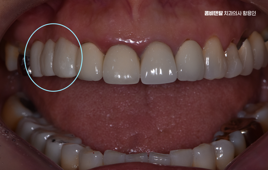 앞니 크라운 교체 깔끔하게 정리하려면 관련 이미지 7