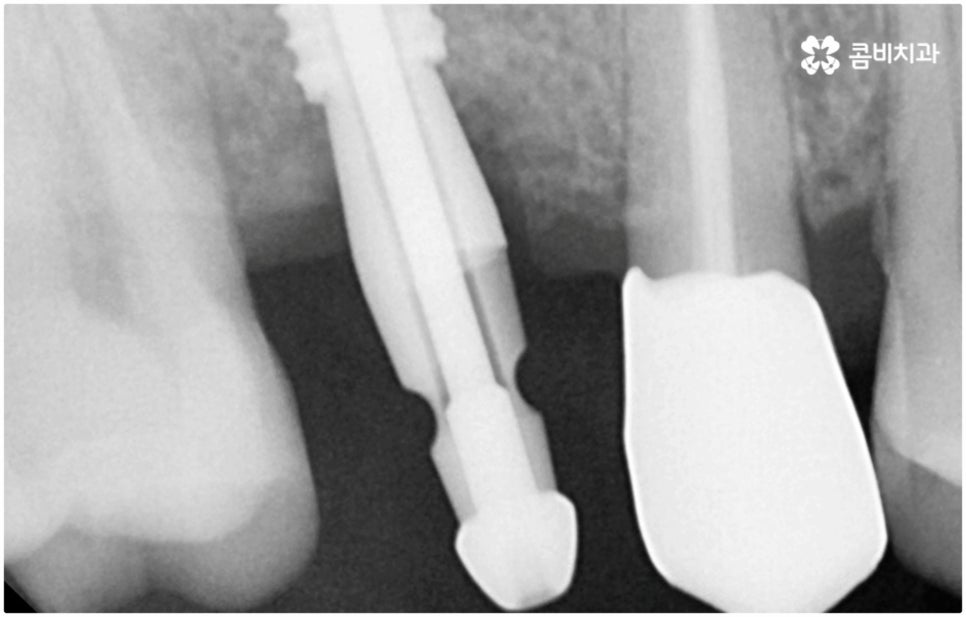 발치후 임플란트 바로 되나요? 관련 이미지 13