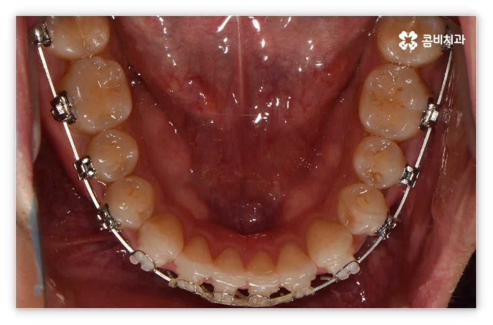 앞니설측교정 망설여질때는 관련 이미지 11