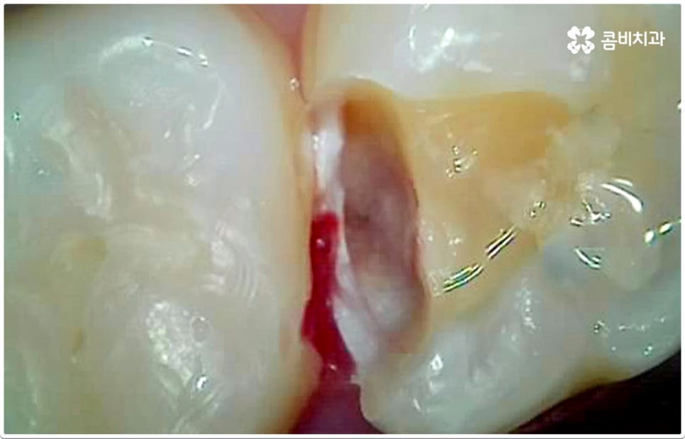 치아사이충치 놔두면 안돼요 관련 이미지 3