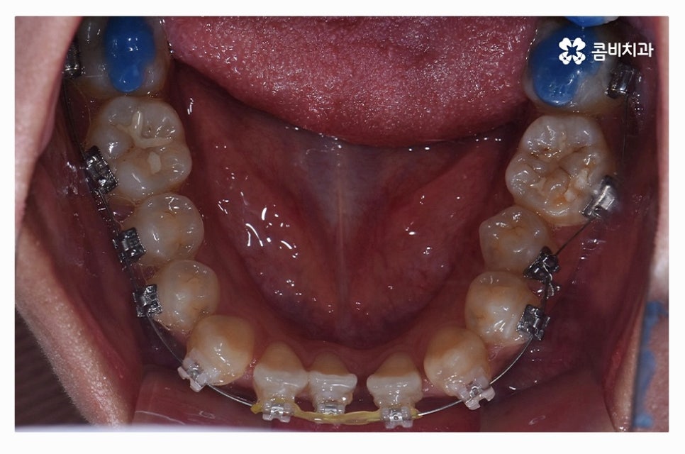 덧니교정 정교하게 따져보려면 관련 이미지 11