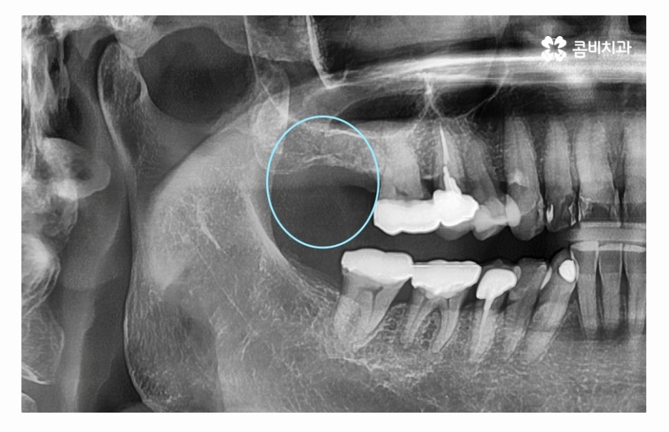 임플란트수술 제대로 알고 선택하려면 관련 이미지 2