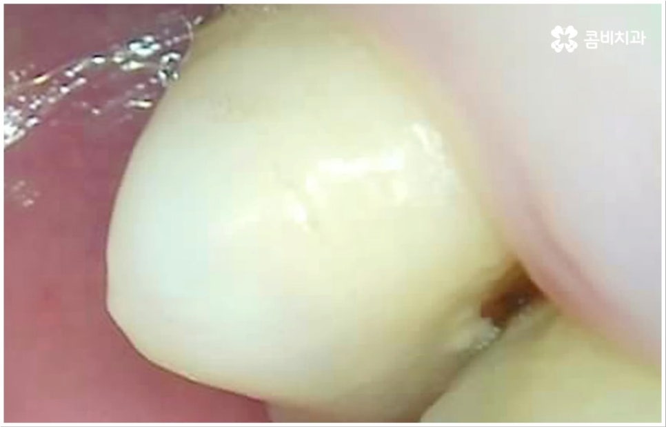 충치 통증 참지마세요 관련 이미지 3