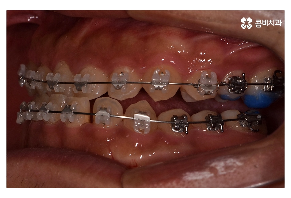 클리피씨교정 늦지않게 결정하려면 관련 이미지 8