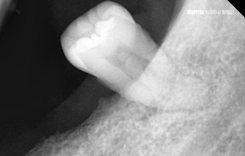 어금니 발치후 임플란트 안하면 어떻게 변하는걸까 관련 이미지 6