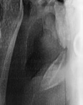 어금니 뒤 잇몸 부음 어떤 문제길래 이런거죠 관련 이미지 27